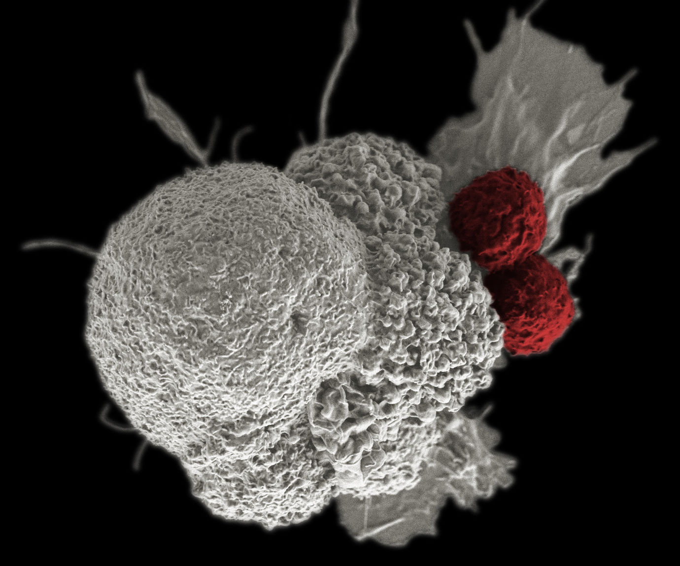 Cancer cell with T cells