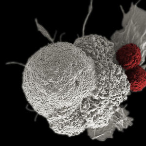 Cancer cell with T cells