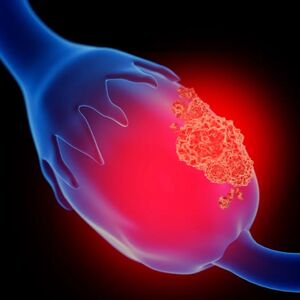 Ovarian tumor